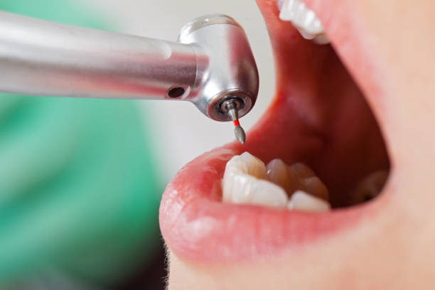 Best Emergency Dental Care for Broken or Chipped Teeth in Briggs, OK